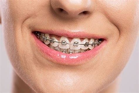 metal brackets teeth|3 types of braces.